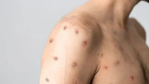 Rio Branco notifica possível caso de Mpox e saúde reforça vigilância no estado