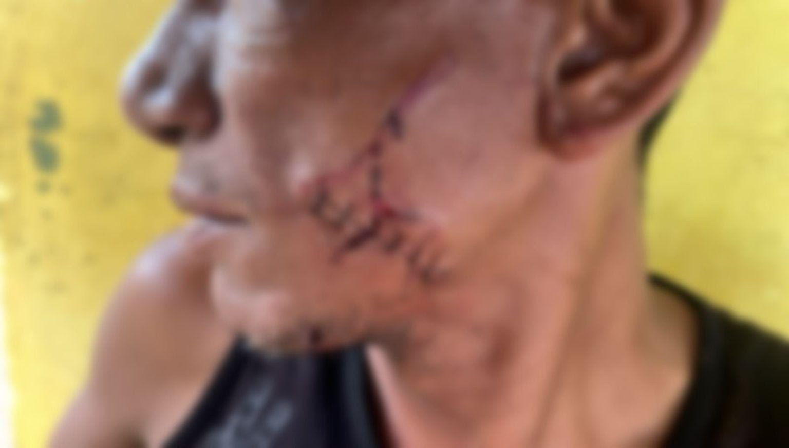Homem fica com ferimento profundo no rosto após ser atingido com garrafa