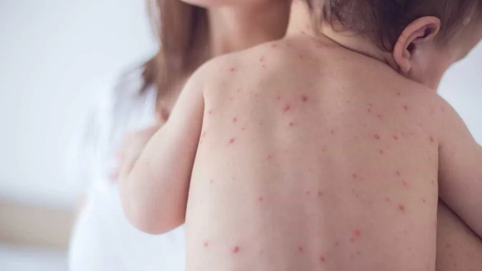 São Paulo registra 14º caso de sarampo, e paciente é um bebê