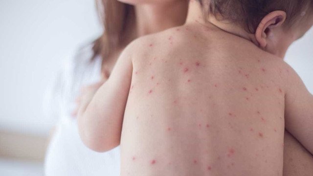 SP confirma 2 novos casos de sarampo e estado soma 7 infecções em 2026