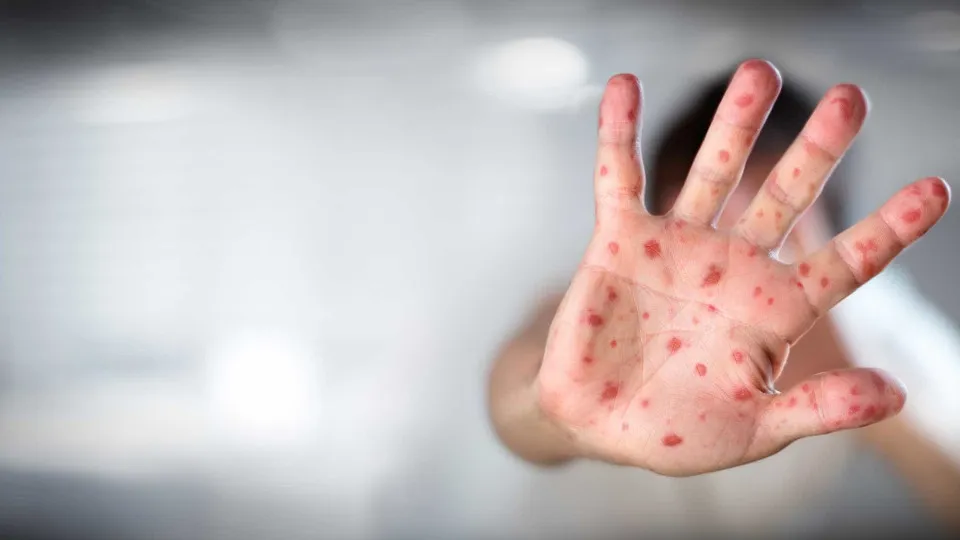 Entenda o que é a amnésia imunológica do sarampo que pode aumentar o risco de outras infecções