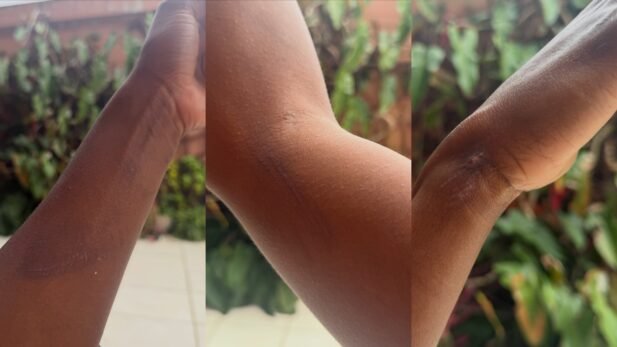 Dandara também ficou com os braços machucados. (Foto: Reprodução/Instagram)